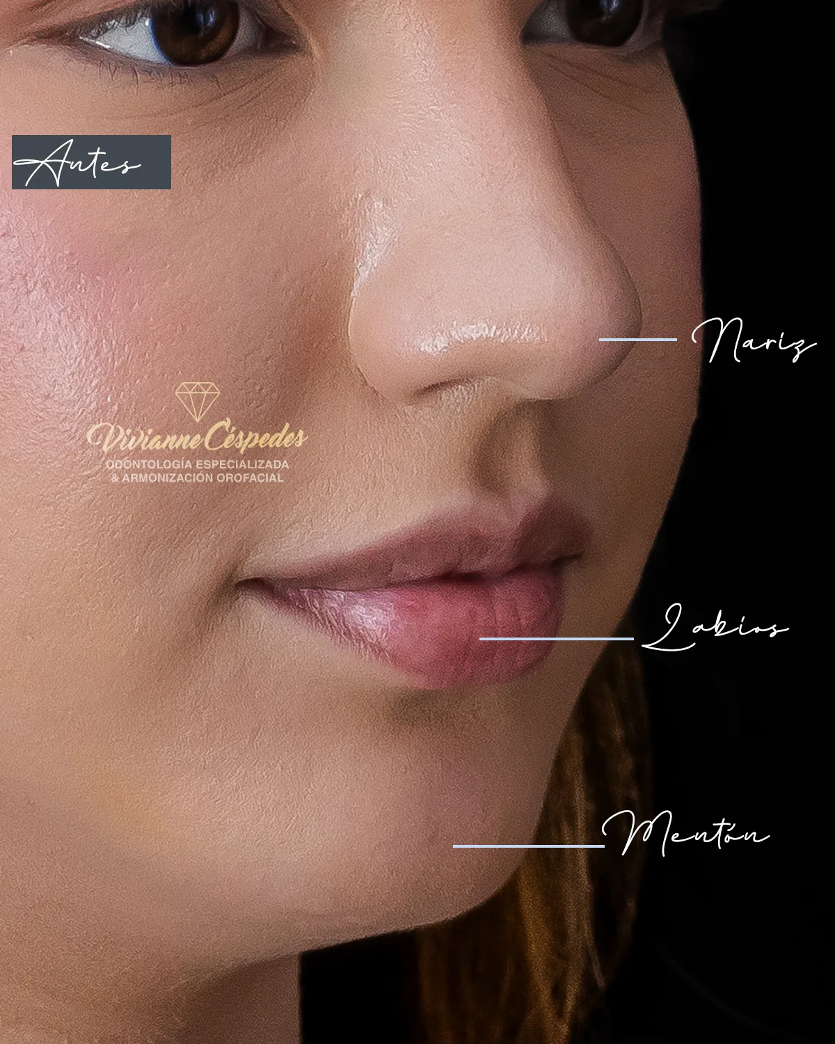 Después — Armonización Facial · Toxina Botulínica + Ácido Hialurónico