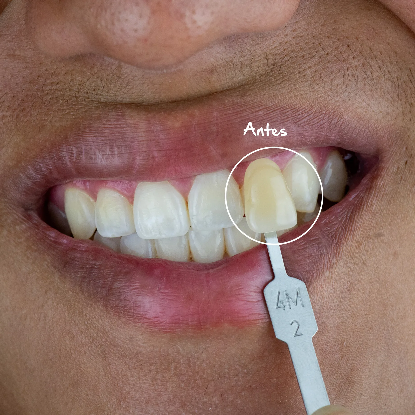 Después — Limpieza Dental Profesional · Blanqueamiento