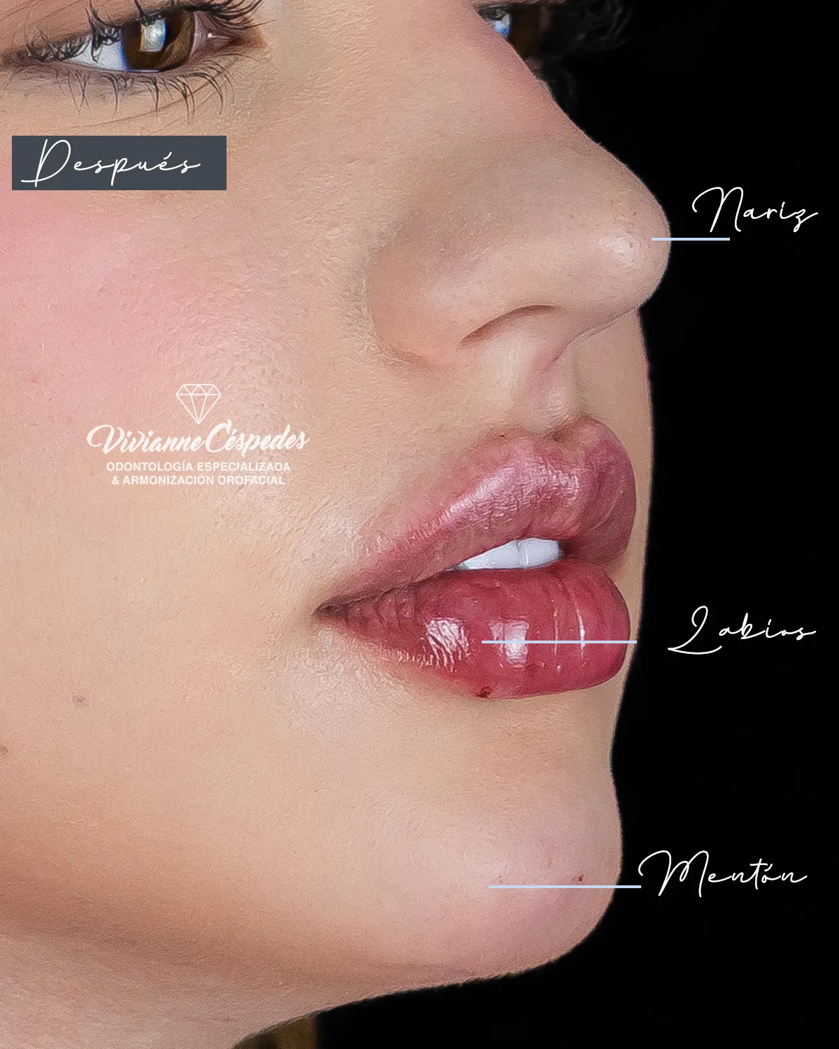 Antes — Armonización Facial · Toxina Botulínica + Ácido Hialurónico