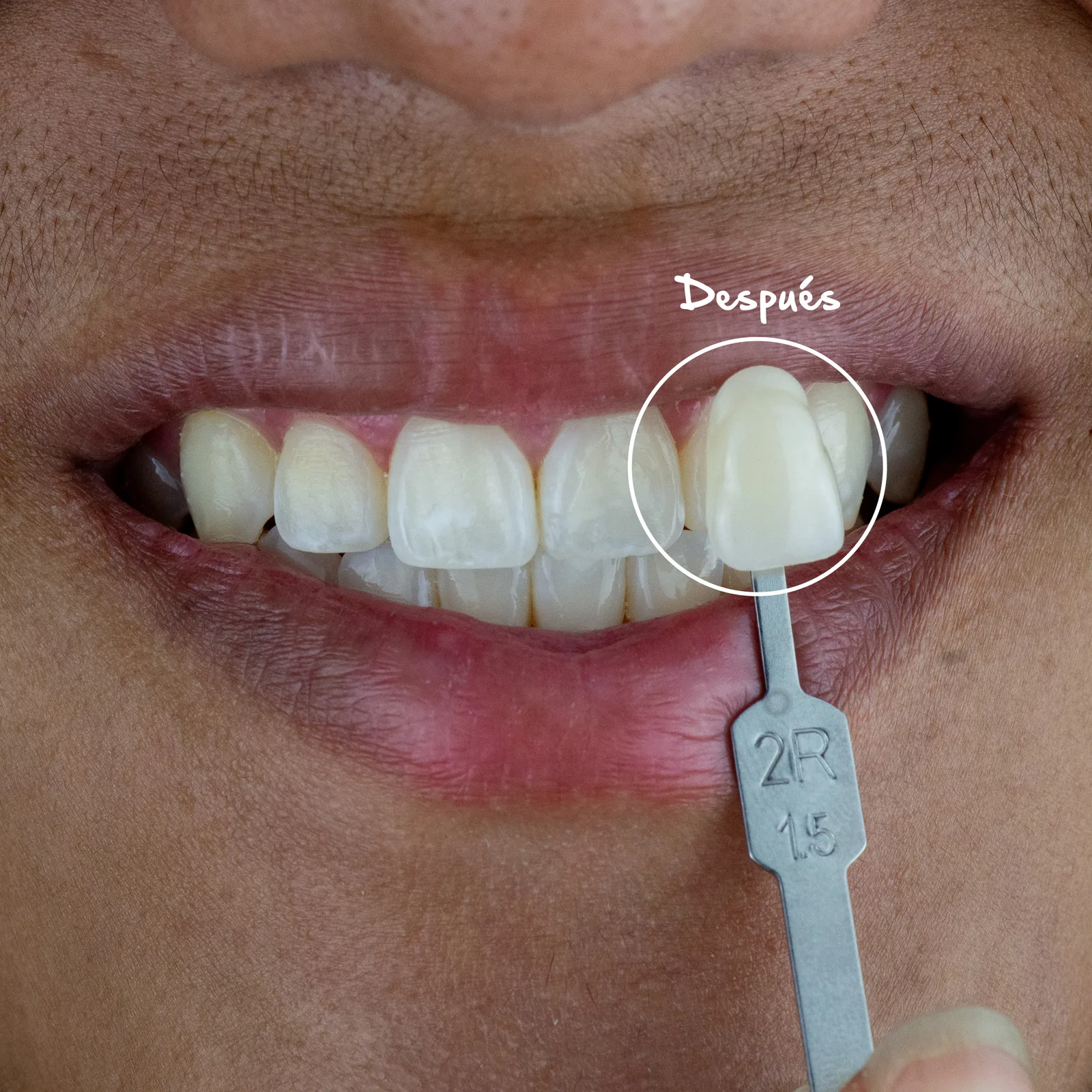 Antes — Limpieza Dental Profesional · Blanqueamiento